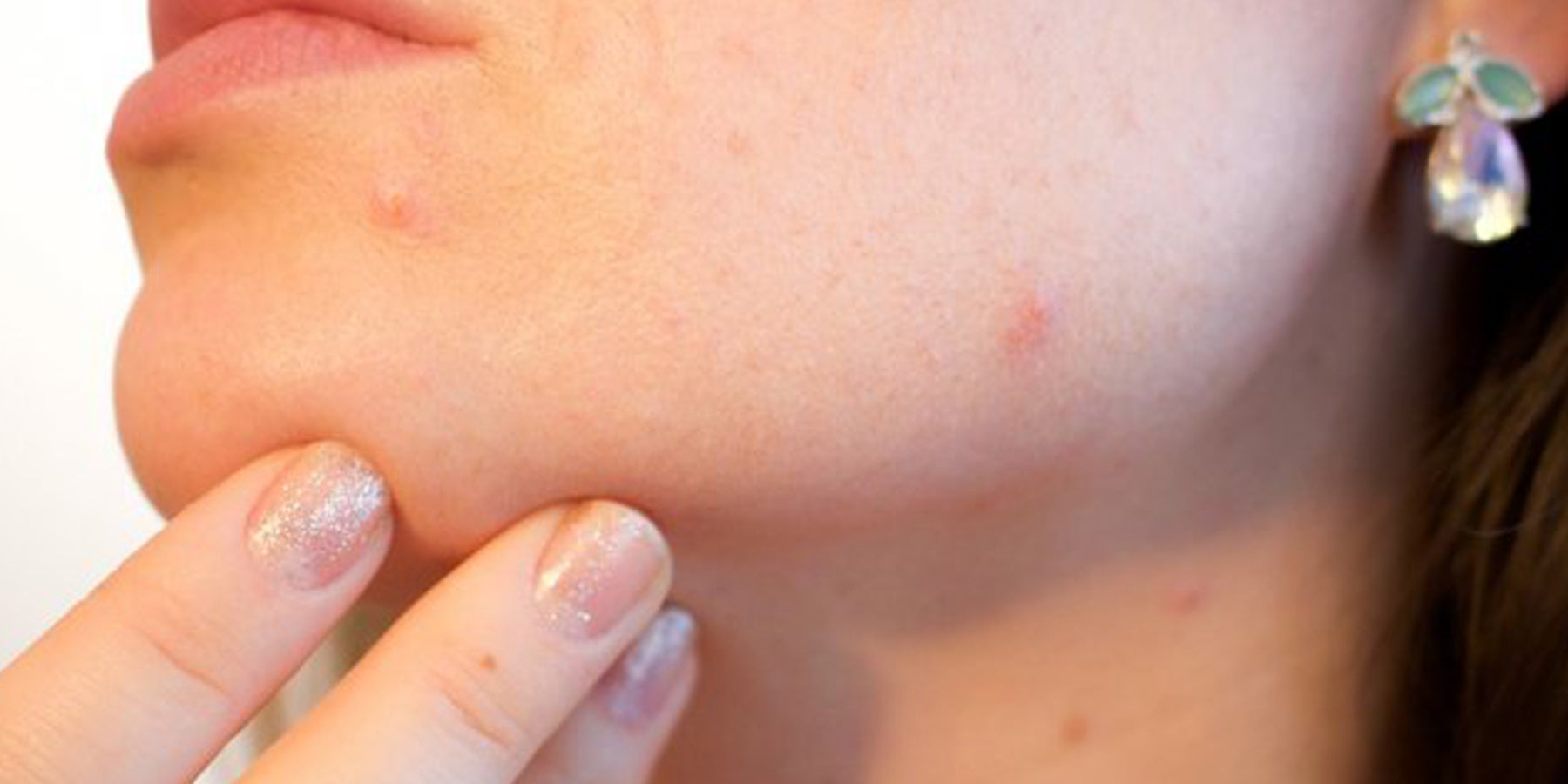 5 Tips tegen jeugdpuistjes, voor een prachtig gave huid